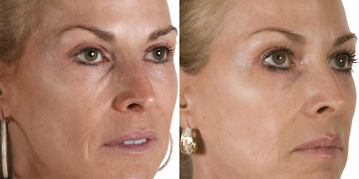 microneedling exosome before and after